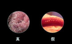 尖锐湿疣潜伏期症状,尖锐湿疣潜伏期的早期迹象与预防措施