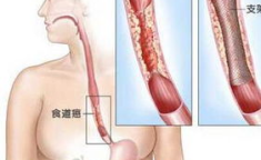 食道癌的早期症状,五大症状警示健康危机